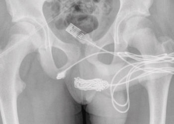 Teen Gets USB Cable Stuck in His Penis in Botched Measuring Attempt