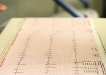 ‘Broken Heart Syndrome’ Cases Surge During Pandemic With Women More Likely to Be Diagnosed