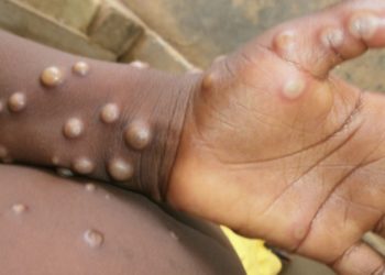 UK Health Experts Report Four New Cases Of Rare Monkeypox Virus