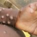 UK Health Experts Report Four New Cases Of Rare Monkeypox Virus