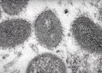 Texas Health Department Reports First Death of Person Diagnosed With Monkeypox, Investigation Underway